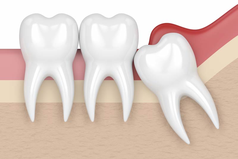 Wisdom Tooth Removal in Los Angeles